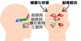 急性・慢性副鼻腔炎