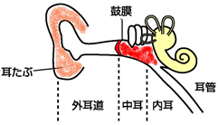 急性中耳炎