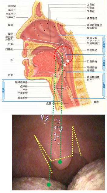 いびきに対する軟口蓋形成手術